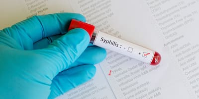 ¡Se encienden las alarmas! Los casos de sífilis aumentan en América 